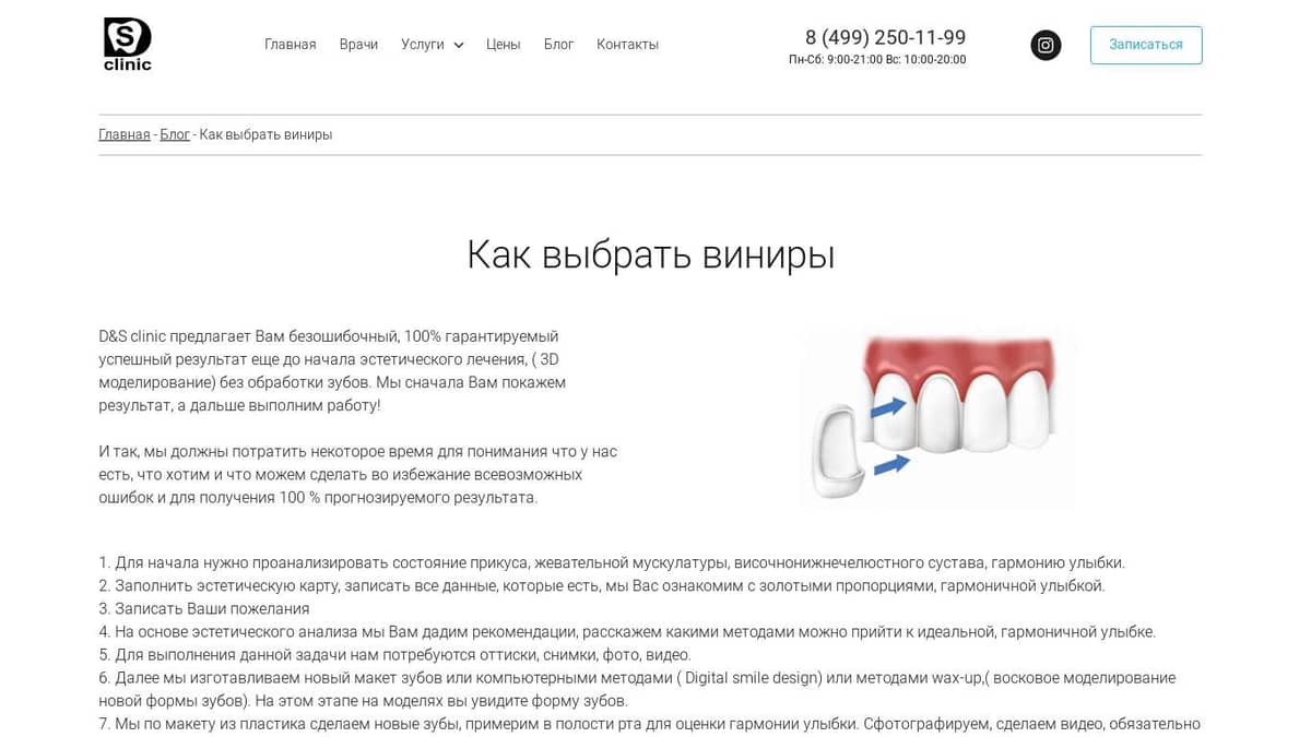 Как выбрать виниры